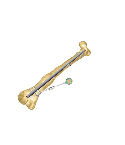 Fitbone-TLN-Femur-Retrograde_NEW.jpg
