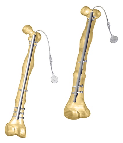 Fitbone_Femur_Antegrade_application.jpg