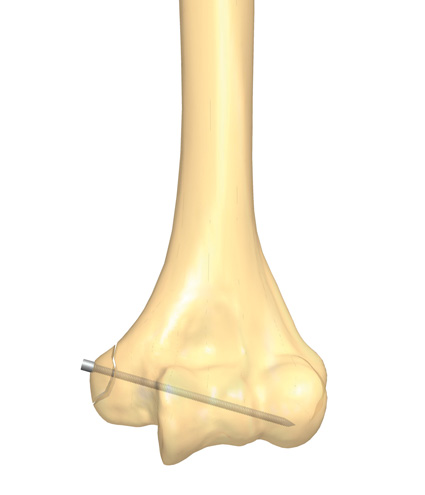 Humerus_Fractures_16.jpg