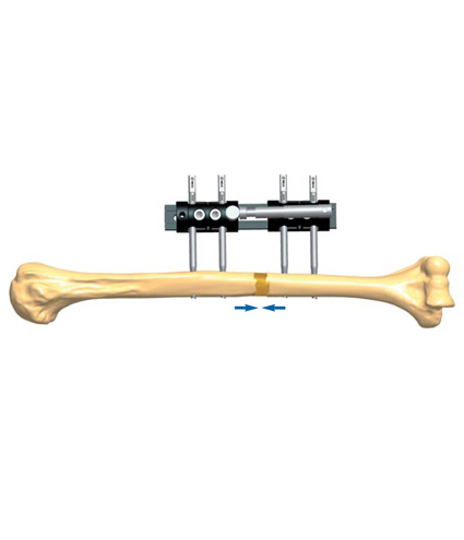 Humerus_NonUnion_3.jpg