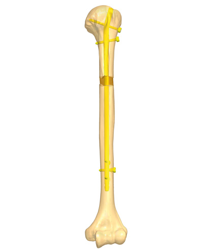 Humerus_NonUnion_4.jpg