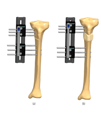 Tibia_Lengthening_1.jpg