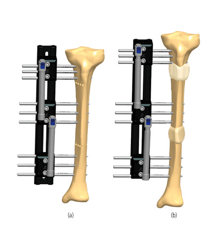 Tibia_Lengthening_3.jpg