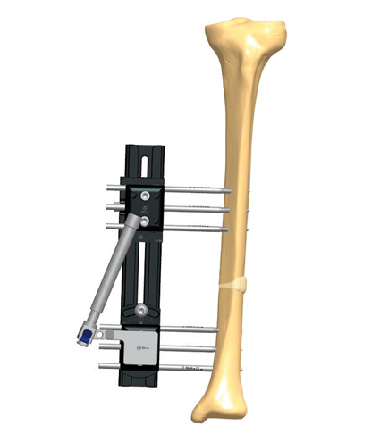 Tibia_Lengthening_4.jpg