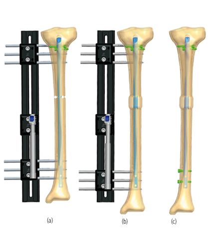 Tibia_Lengthening_5.jpg